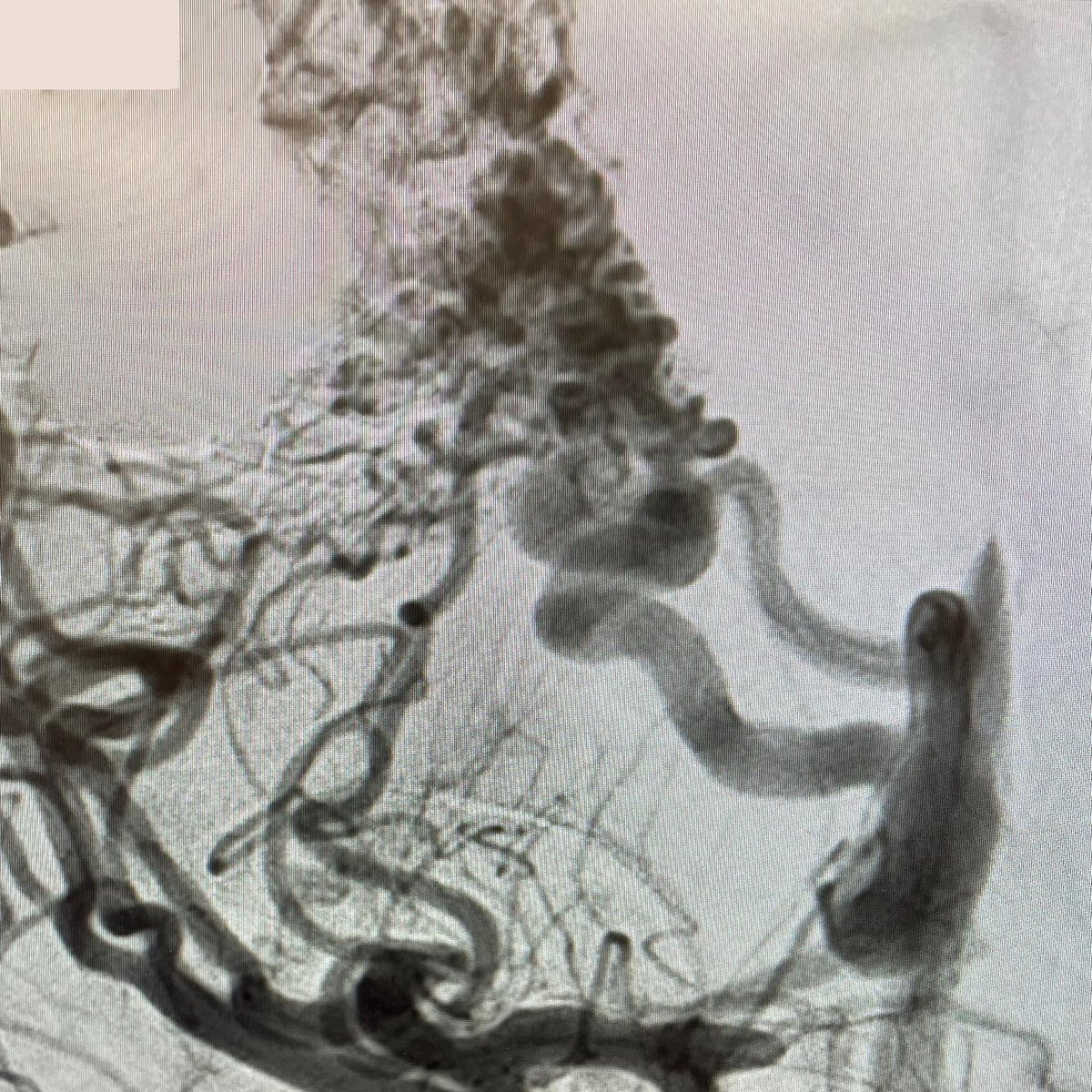 VascNeuro's tweet photo. 23M presented to ED after having intermittent seizures, headache, numbness, and tingling in LT upper &amp; left lower extremities. Nidus measured 6.5cm x 5.5cm. 7cc Onyx, used to embolize. Retreated 3 months later with another 8cc Onyx. 1mm x 1mm residual. #neuroscience #neurology https://t.co/8QMzrsSzPr