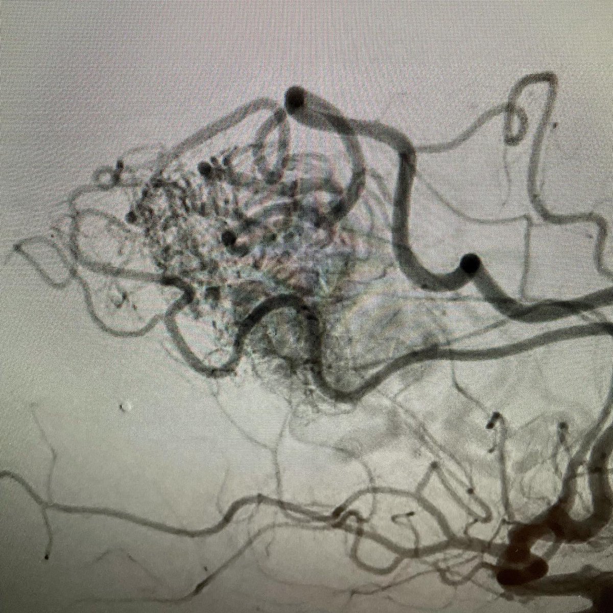 VascNeuro's tweet photo. 23M presented to ED after having intermittent seizures, headache, numbness, and tingling in LT upper &amp; left lower extremities. Nidus measured 6.5cm x 5.5cm. 7cc Onyx, used to embolize. Retreated 3 months later with another 8cc Onyx. 1mm x 1mm residual. #neuroscience #neurology https://t.co/8QMzrsSzPr