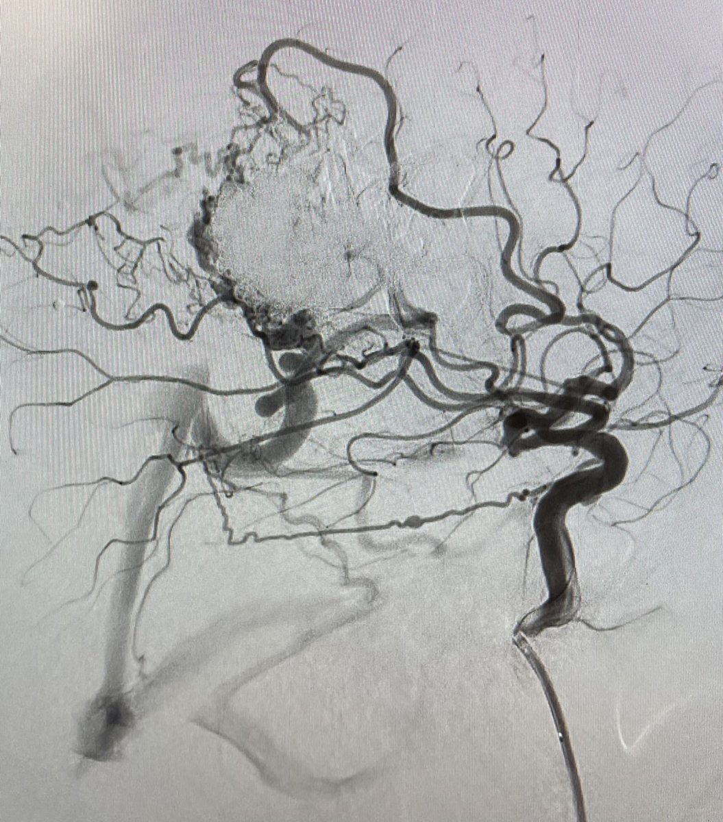 VascNeuro's tweet photo. 23M presented to ED after having intermittent seizures, headache, numbness, and tingling in LT upper &amp; left lower extremities. Nidus measured 6.5cm x 5.5cm. 7cc Onyx, used to embolize. Retreated 3 months later with another 8cc Onyx. 1mm x 1mm residual. #neuroscience #neurology https://t.co/8QMzrsSzPr