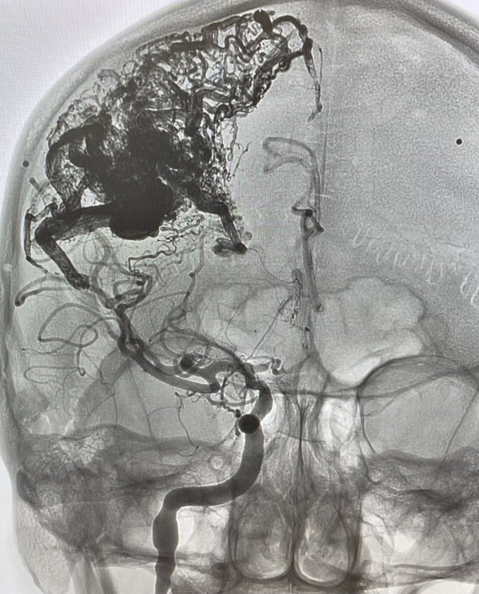 VascNeuro's tweet photo. 23M presented to ED after having intermittent seizures, headache, numbness, and tingling in LT upper &amp; left lower extremities. Nidus measured 6.5cm x 5.5cm. 7cc Onyx, used to embolize. Retreated 3 months later with another 8cc Onyx. 1mm x 1mm residual. #neuroscience #neurology https://t.co/8QMzrsSzPr