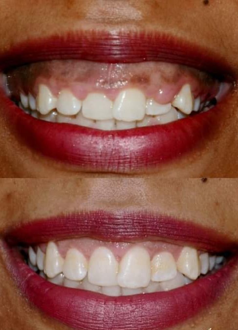 SerembaPatrick's tweet photo. Imagine working on your gums and leaving your makeup 💄 intact 😁😁. Let's start your smile journey together 😘. Do you love it 😍
#GingivalHyperplasia
#Gingivectomy
#GumTreatment
#DrSseremba
#HappyNewMonth https://t.co/VbytbjCXlP