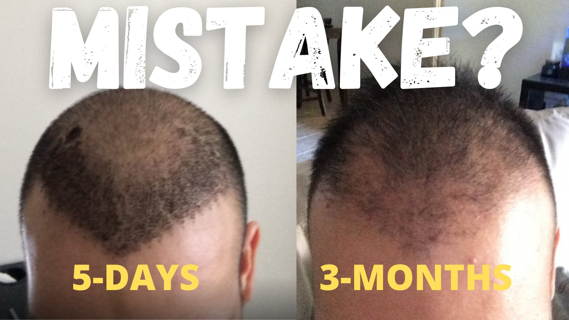 تويتر \ Hair Transplant Network على تويتر: تويتر \ Hair Transplant Network على تويتر: