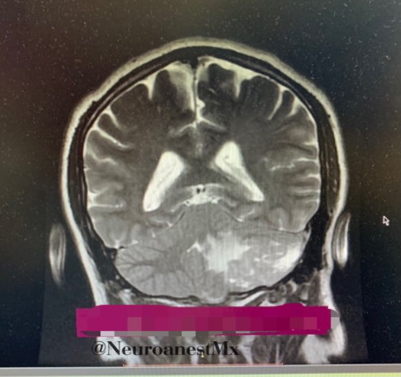 NeuroanestMx's tweet photo. Resection of #medulloblastoma

Male 39 years old.  vertigo and gait disturbance 2 months of evolution. MRI shows a left cerebellar lesion.

#anestheticmanagement: Propo-Remi-Lido + type 2 monitoring. Neuromonitoring with #bismonitor
Right Park Bench position. https://t.co/bUylrf8WUh