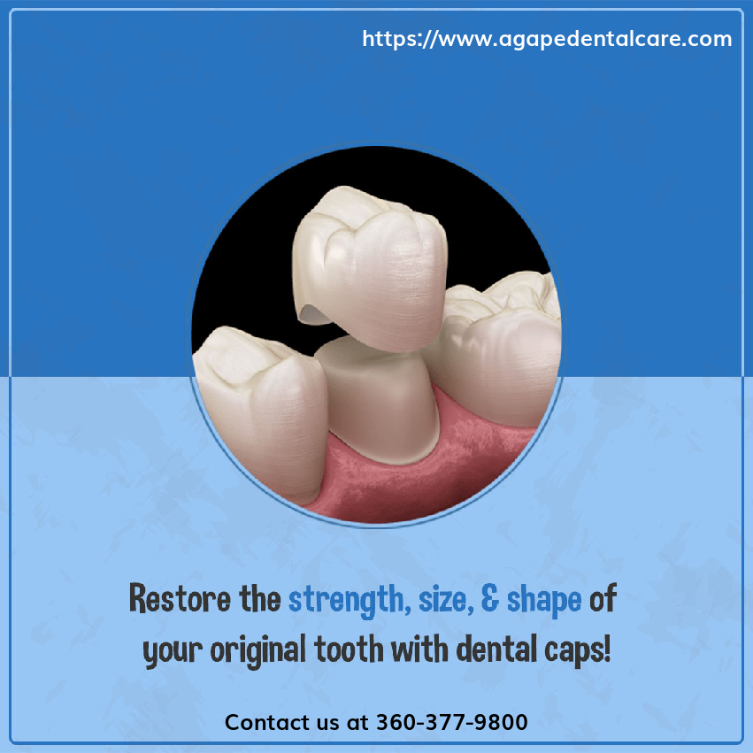 AgapeDentalCare's tweet image. Did you know dental caps can help fix chipped, cracked, or damaged teeth without having to operate fully?
Let's shape your perfect smile again with our affordable &amp;amp; safe caps!
 #Caps #TeethCaps #DentalCaps 
 #agapedentalcare