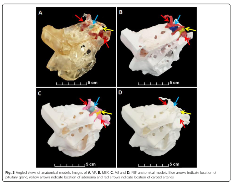 Dan_J_Gillett's tweet photo. #3Dprinting of pituitary tumours. We critically compared four 3D printing techniques and also asked @CUH_NHS and @Cambridge_Uni experts their opinions. The article is available here https://t.co/UprLTm15Gg 
@djmars811 @BioMedCentral @josefprusa https://t.co/jZQgDcfDAw