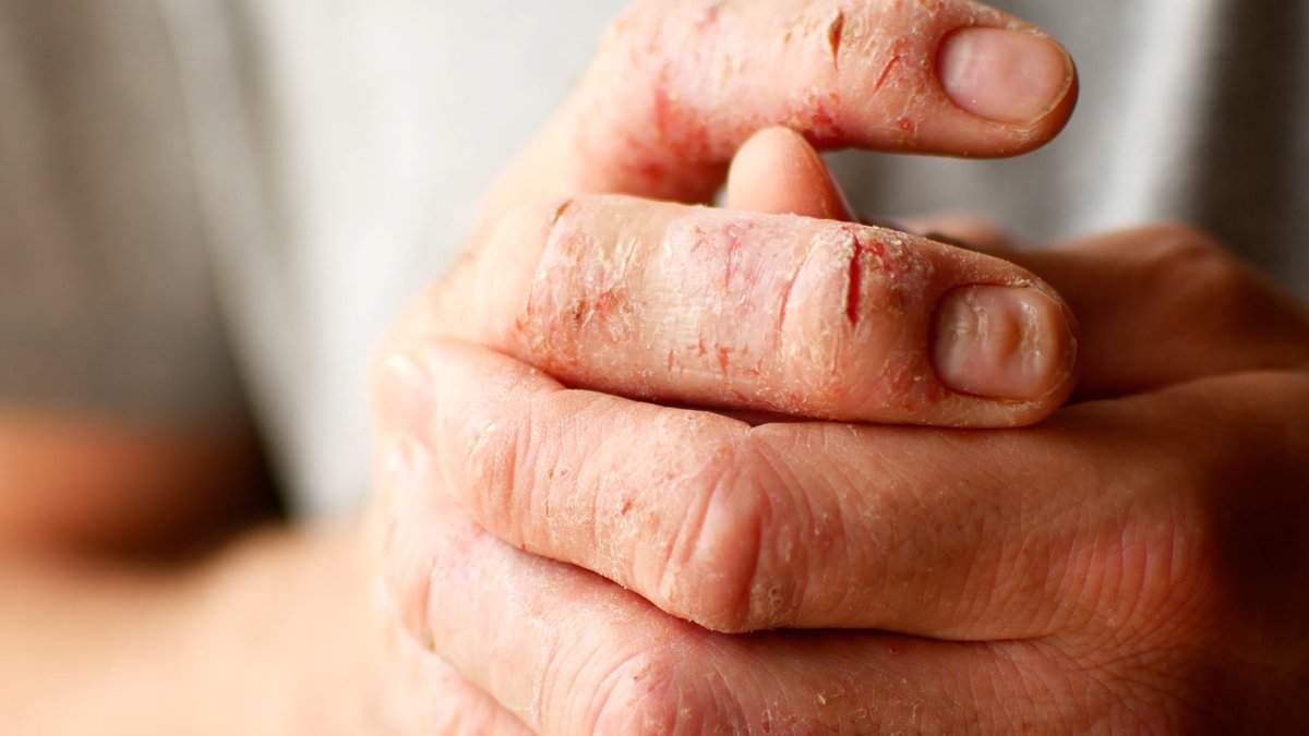 axisbiotix's tweet image. 2-3% of the world population or 125 million people have psoriasis, according to the World Psoriasis Day consortium: bit.ly/38jwBKO #Psoriasis