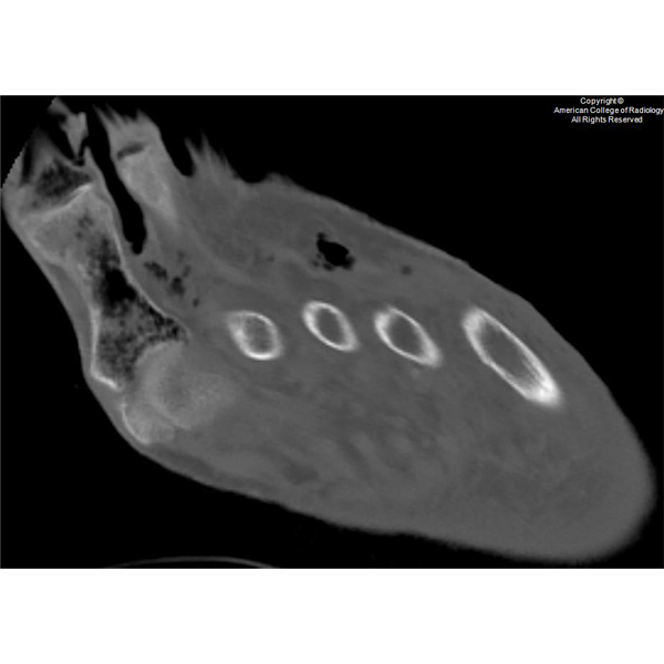 An 84-year-old woman with a history of end-stage renal disease, peripheral arterial disease, and atrial fibrillation presents with an altered mental status. bit.ly/3iVErzh #ACRCaseinPoint