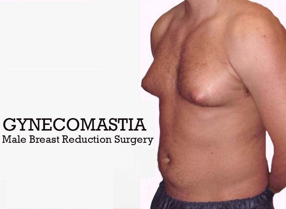 Gynecomastia India on X: The goal of #gynecomastia treatment is to reduce breast  size in men who are embarrassed by overly large breasts. Reduction methods  include #liposuction, cutting out excess glandular tissue