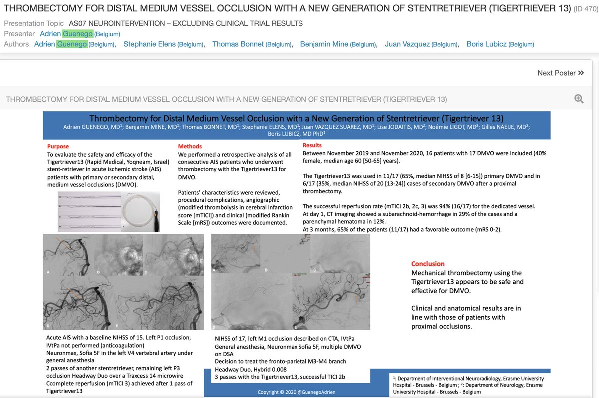 GuenegoAdrien's tweet image. #Thrombectomy for #DMVO can be performed using the #TigerTriever13 @Rapid__Medical 
#Stroke #ESOC2021 #NeuroIRTip 

@ESOstroke @esmintsociety @JeremyHeitMDPHD @stanfordneuroi1 @Fie0815 @PascalMosimann @Aggour @AmeerEHassan @PascalJabbourMD @NeuroUnited