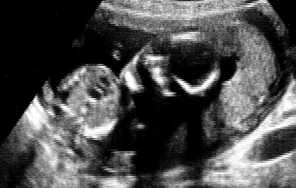 chalaw500's tweet photo. (1) The new draconian Texas anti-abortion law got me to thinking about the incredibly rare cases where Intended Parents need to ask their Surrogate to terminate a pregnancy because the fetus is developing with a life-threatening condition. https://t.co/r12oW5HL7H