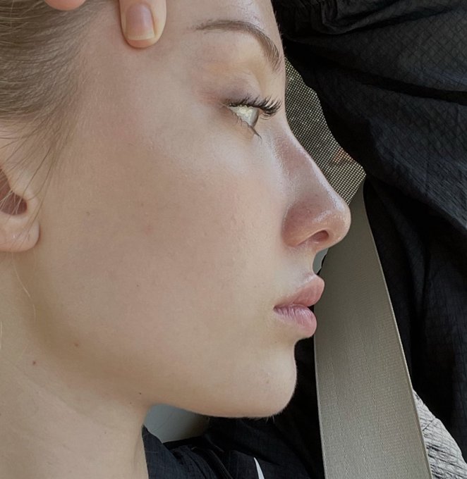 nose job before n after https://t.co/OS7y1vLtDB