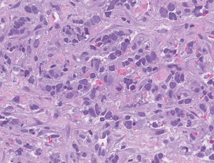 SibaElHussein's tweet photo. #LessonsfromtheFridayUnknowns relapsed CD3+ pleomorphic mantle cell lymphoma shown by @ljmedeirosMD during #LJMFridayUnknowns➡️https://t.co/prZIPg0IXl
#hemepath #PathTwitter #lymsm 
@KirillLyapichev @RMirandaMD @SkybhatiaMD @Dowhankim @LianqunQiu @henryhmo @ShaoyingLiMD @FVega957 https://t.co/XWO21UtZJH