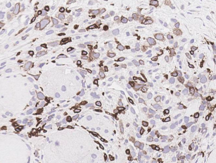 SibaElHussein's tweet photo. #LessonsfromtheFridayUnknowns relapsed CD3+ pleomorphic mantle cell lymphoma shown by @ljmedeirosMD during #LJMFridayUnknowns➡️https://t.co/prZIPg0IXl
#hemepath #PathTwitter #lymsm 
@KirillLyapichev @RMirandaMD @SkybhatiaMD @Dowhankim @LianqunQiu @henryhmo @ShaoyingLiMD @FVega957 https://t.co/XWO21UtZJH