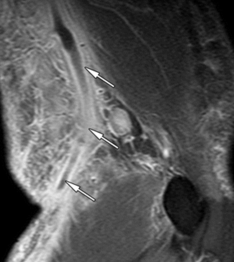 RadG_Editor's tweet photo. The dreaded necrotizing fasciitis—who doesn't fear this dx on call? Lifesaving review of soft-tissue infections of all kinds (and mimics!) for #radres &amp; all rads, from @RossFrederick8 in this @RadioGraphics podcast

https://t.co/6sm03AkOMn https://t.co/sVBZpmIVYI