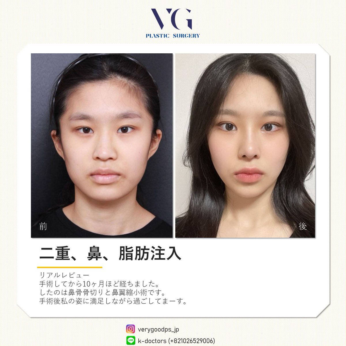 verygoodps_jp's tweet photo. ナチュラルに変わりたいですか？
ベリーグッド整形外科で隠されている本人の魅力をお探しください！
#鼻形成 #鼻先形成 #脂肪注入 #脂肪移植 https://t.co/d3vTDGX4i7