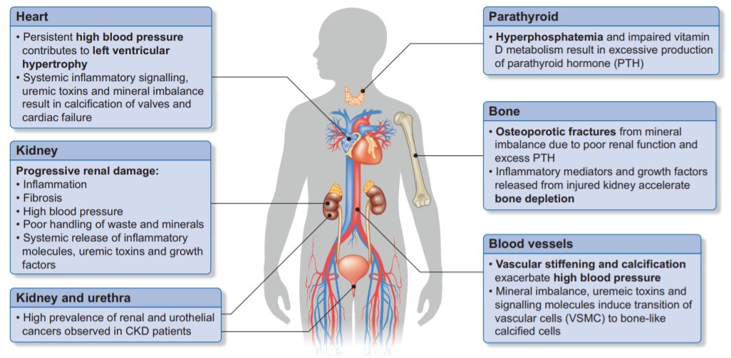 NDTsocial's tweet photo. 📣Editor's Choice from September issue:
Midkine and chronic kidney disease-associated multisystem organ dysfunctions 
📸Multi-organ dysfunction associated with #CKD
🔓https://t.co/cw9RIXuTPt👈
#biomarker #Midkine @KrishRathika https://t.co/suxlCgfo0F