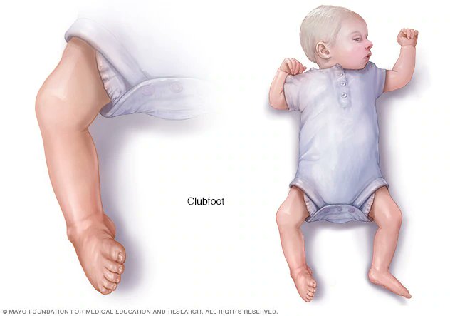 QatadahFayomi's tweet photo. "Club foot" 🦶🏼
- a condition in which a newborn's foot or feet appear to be rotated internally at the ankle

- mnemonic: 🧐
CAVE 🌌
C: Cavus
A: Adductus
V: Varus
E: Equinus https://t.co/1CFS9SCKvg