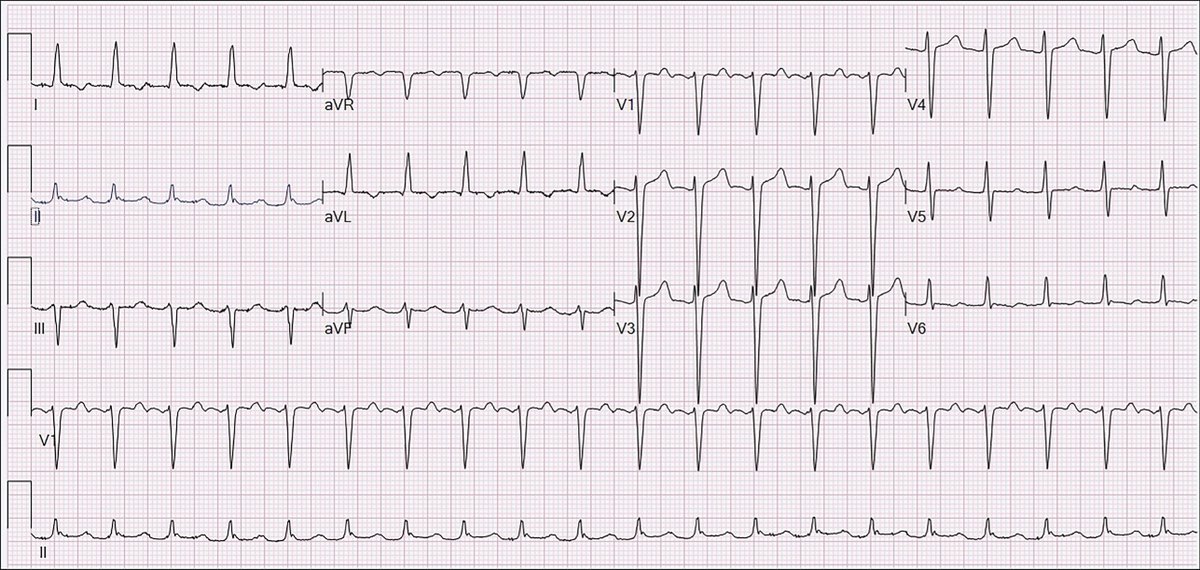 1/ ⚡️Want to up your EP game?⚡️ Here is a case-based tweetorial teaching a simple trick to make you look like a pro. #ACCFIT #EPeeps #Cardiotwitter By @TJHeartFellows @NoahHaroian @AHajduczok + EP attending @FrischMd Cardiac surgery consult - post op, stable, and this #ECG