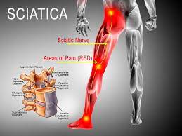 The difference between piriformis syndrome and sciatica, ow.ly/Lb7e50G35ci #piriformissyndrome #sciatica
