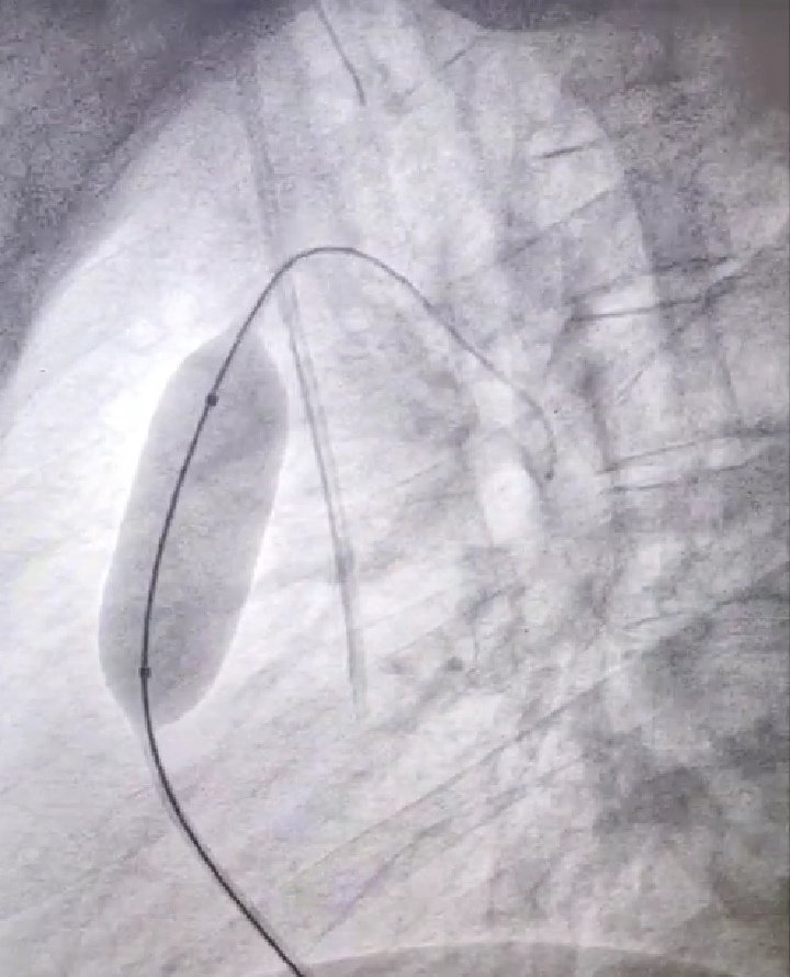 Thank you #picsymposium2021 to give us the opportunity to participate in this great meeting by conducting two successful live cases from Jeddah to Las Vegas. The @PICS_AICS put tremendous efforts to make this meeting one of the top meetings in the world in cong/struct ❤️disease.