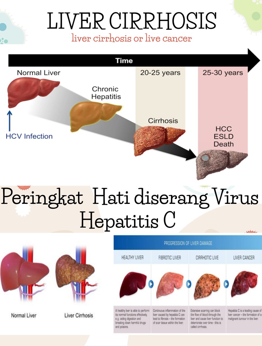 uequals2u's tweet photo. There are 4 stages of liver damages after getting Hepatitis C Virus
Terdapat 4 peringkat hati diserang Virus Hepatitis C
#MyMissingMillions #HepatitsC #Hepatitis #AkhiriCovid19 https://t.co/Qb5Qb7ZxX6