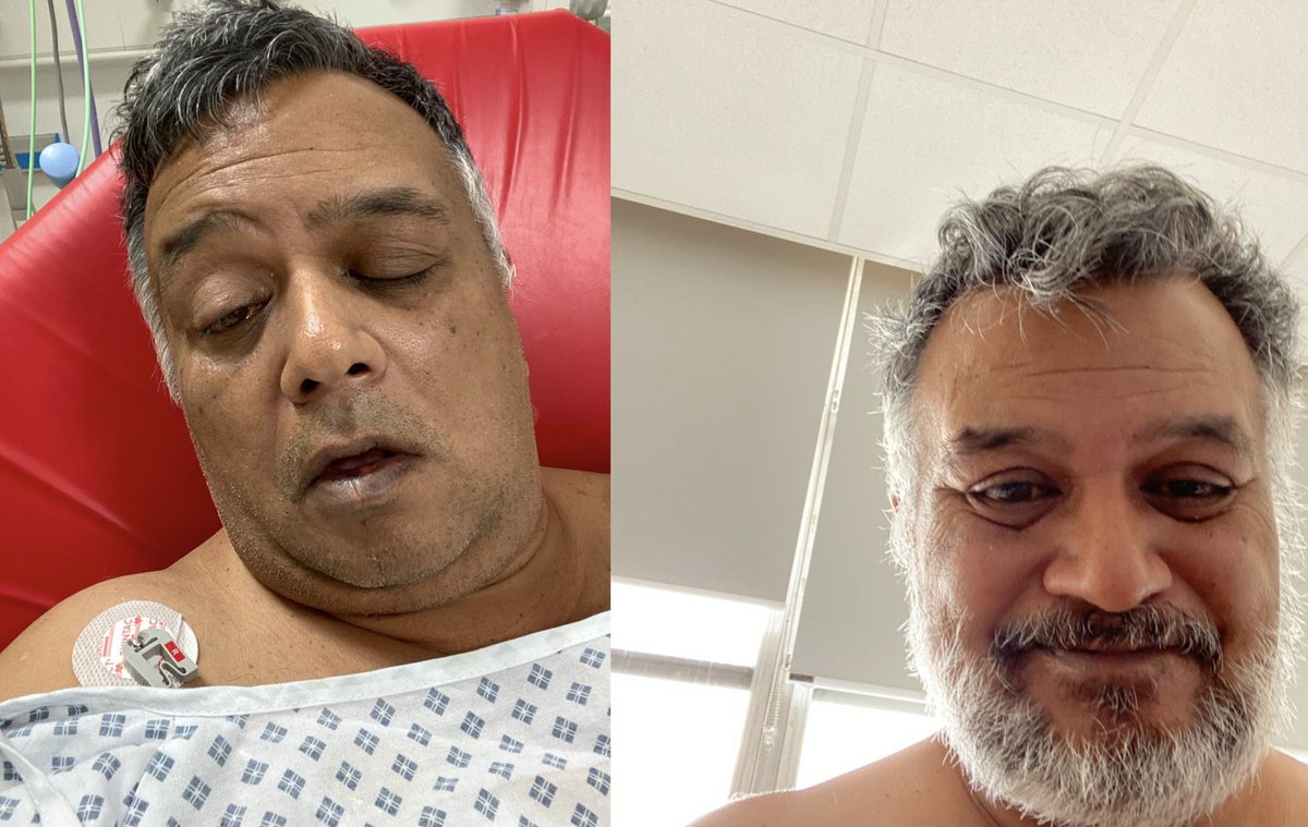 where2mate's tweet image. Recovery is going as well as can be. Nearly 5 weeks ago (1st photo) I had a stroke. The 2nd photo is recent. I still haven’t recovered my swallow but I’m hoping to be discharged next week. Thank you again for all the love. I really appreciate it 😘
#Stroke #Recovery #Believe