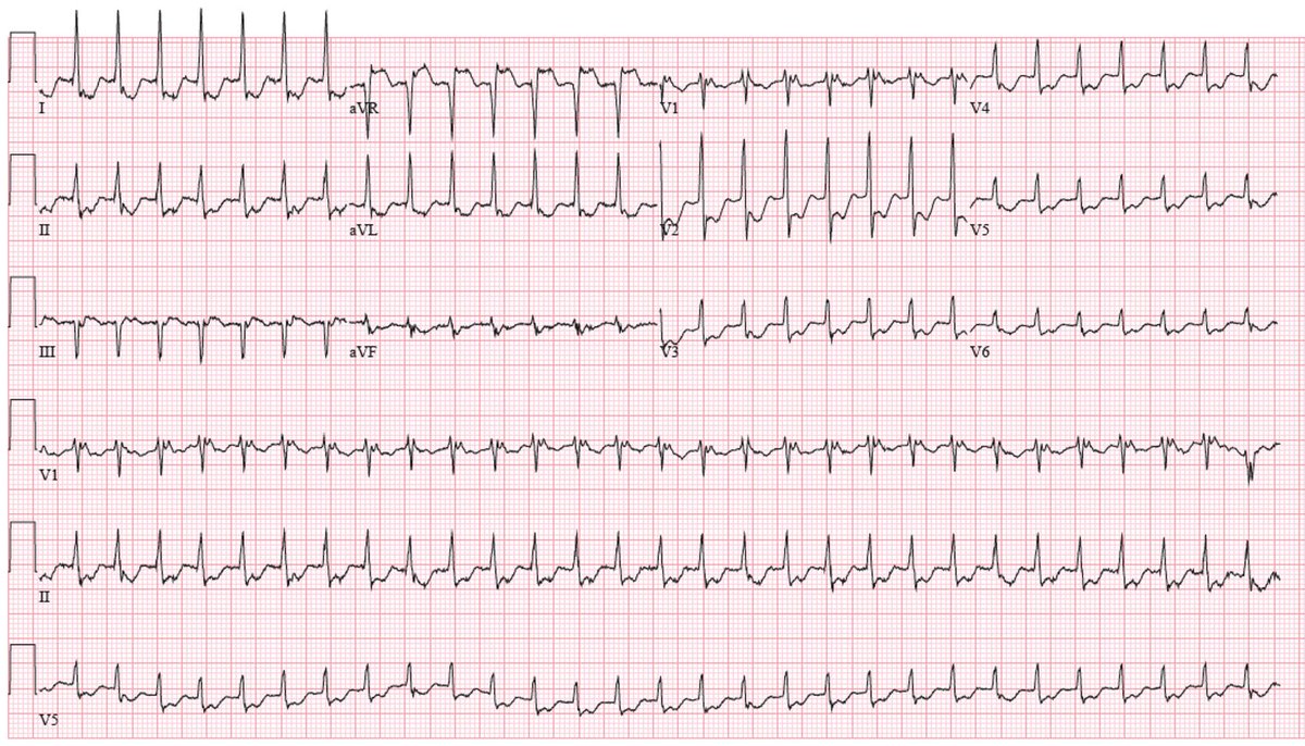 One of the selected winners🏆for the ECG Teaching Competition in #JACCCaseReports. An entire issue devoted to the electrocardiogram! jacc.org/doi/10.1016/j.… 
#ECGChallenge #ECG #Cardiotwitter #EPeeps #Cardiology #CardioEd #MedEd #Medtwitter @JACCJournals @JGrapsa @Dr_Santangeli