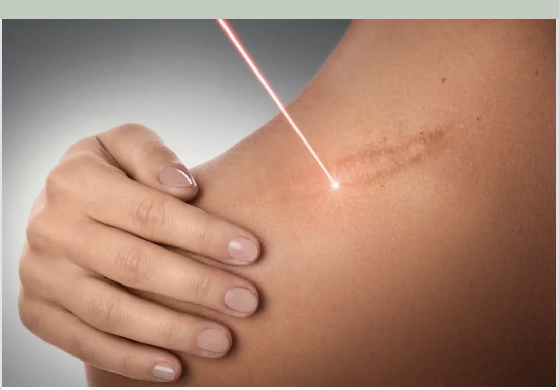 سلسلة تغريدات عن دور الليزر في تحسين الندبات الجراحية.

بداية هناك ثلاثة مبادئ مهمة:
١- الهدف من الليزر هو تحسين الندبة وليس إزالتها

٢- لابد من إجراء الليزر بعد التئام الجرح مباشرة للحصول على أفضل النتائج (تقريباً بعد شهر)

٣- عادة مايتكون العلاج من جلسات متعددة وليس جلسة واحدة.