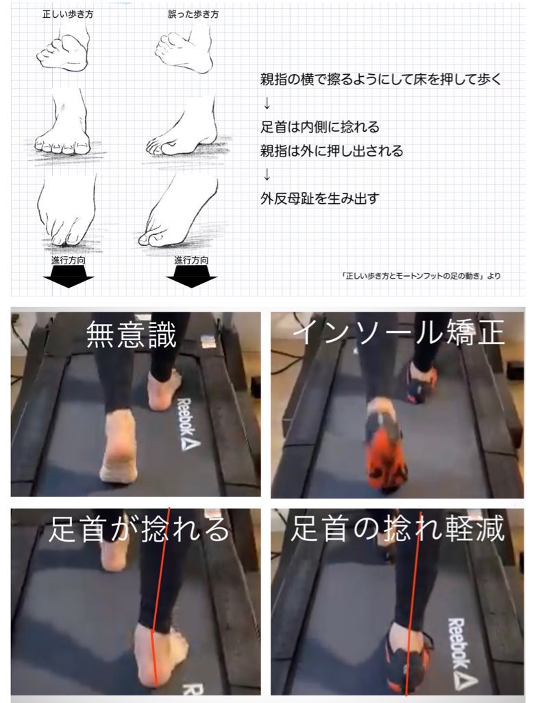 35210re's tweet photo. 美脚=股関節と足首が良好

私
股関節…良好
足首…絶望的に問題山積

"私の場合"脚が太い根本原因は足首かな？と仮説が出たのでインソールで矯正し、真っ直ぐ立つ、真っ直ぐ歩く練習中です。

仮説→行動→フィードバック→修正

の繰り返しですが、人体実験みたいで楽しいの〜。 https://t.co/hz5e4Jrfgj
