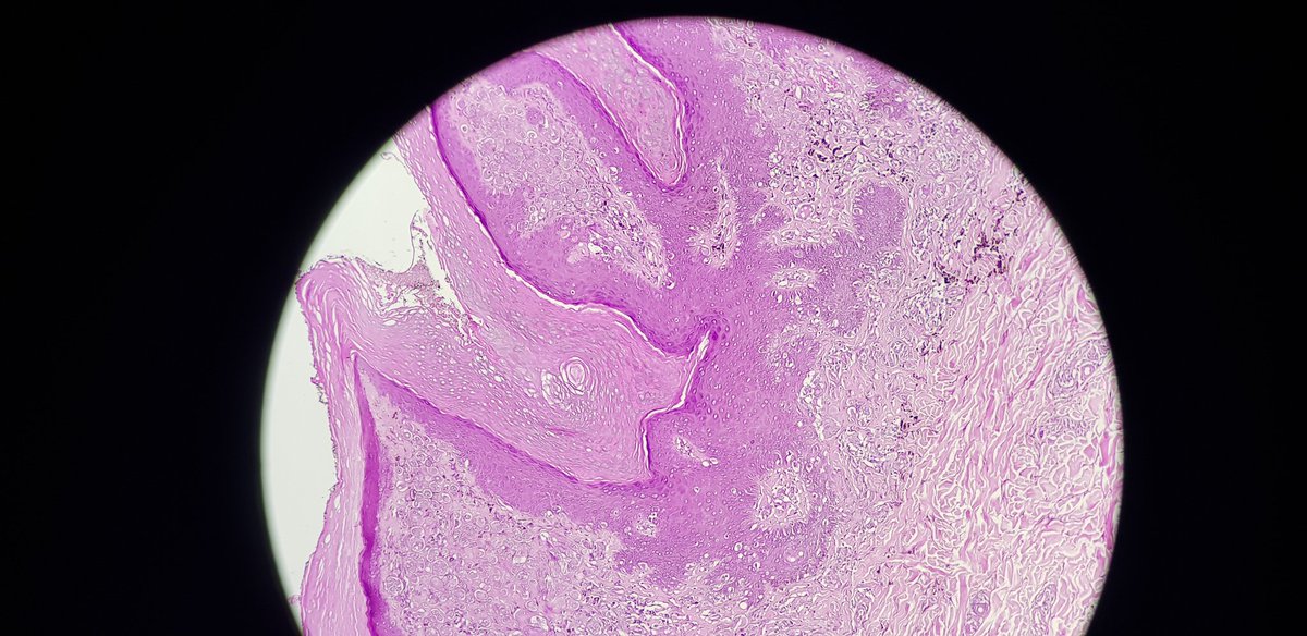 OqKenzaMD_path's tweet photo. Dear #dermpath
9 yo child,  8 mm wart nodule of the ankle
Any thoughts!
#dermpath #skinpathology #dermatology @JMGardnerMD @BeatriceVergier @ESDPath @Der_MDPI @DermatopathFR @LoyolaDermPath @IntSocDermpath @USFDermpath @ESDPath @DermpathJC @SFDermatologie https://t.co/ysvDrz3uue