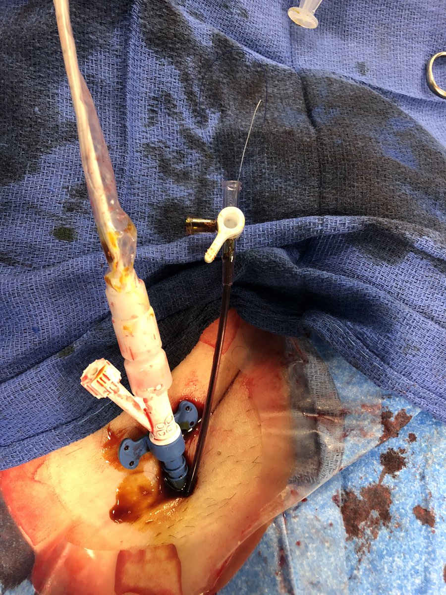 Jeffrey Marbach (@jamarbach) on Twitter photo Trying to keep those preclose sutures sterile. Secured in side arm of the #Impella sheath and dwelled with Betadine. <a href="/duanepinto/">Duane Pinto MD MPH</a> <a href="/DrAmirKaki/">Amir Kaki, MD</a> <a href="/rwyeh/">Robert W. Yeh</a> <a href="/NavinKapur4/">Navin Kapur</a> <a href="/BidmcCvi/">BIDMC CVI</a> Trying to keep those preclose sutures sterile. Secured in side arm of the #Impella sheath and dwelled with Betadine. <a href="/duanepinto/">Duane Pinto MD MPH</a> <a href="/DrAmirKaki/">Amir Kaki, MD</a> <a href="/rwyeh/">Robert W. Yeh</a> <a href="/NavinKapur4/">Navin Kapur</a> <a href="/BidmcCvi/">BIDMC CVI</a>