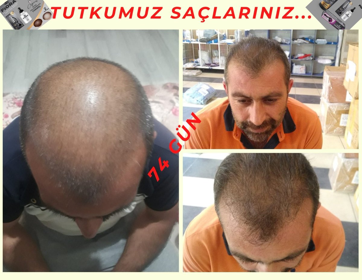 DegisimMucize's tweet photo. Saç ekmiyoruz, çıkartıyoruz,  koruyoruz. 
#Sisli #mecidiyekoy #halkali #Taksim #bagcilar #merter #İstanbul  #bakirkoy #atakoy #bahcelievler #yenibosna #SONDAKIKA #bakirkoy #halkali #İstanbul #avrupayakasi #hairstyle #saçmodelleri #saç #hairtransformations https://t.co/Cw5m5UkMoH