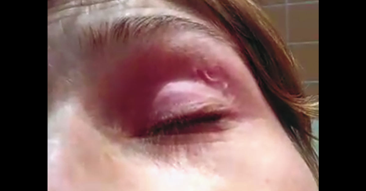 A woman presented with a moving wormlike structure in her left eyelid after she had traveled to the Central African Republic. nej.md/3m1jkhX