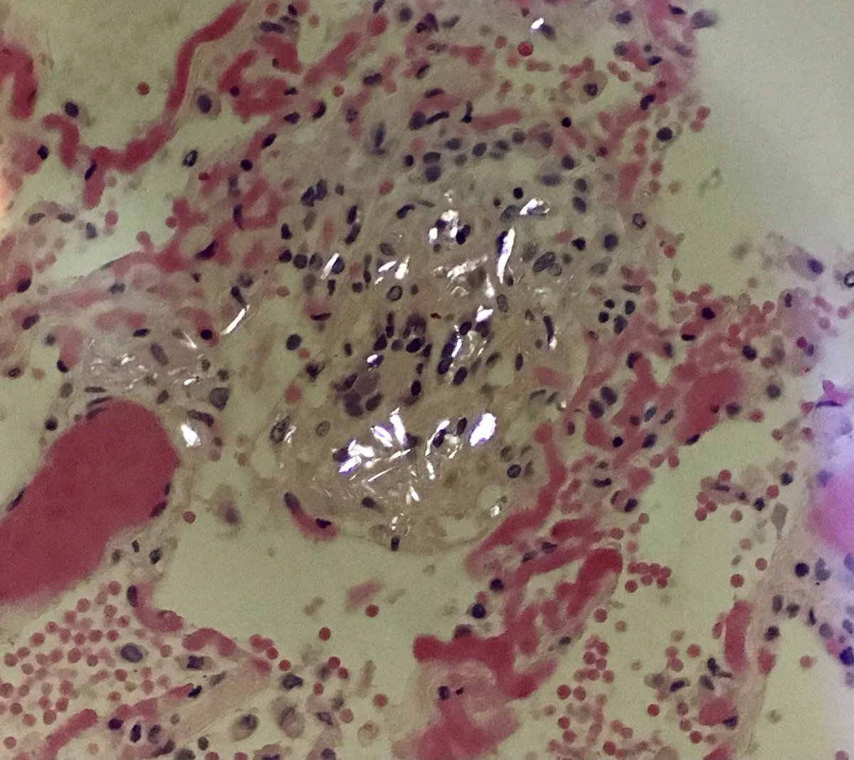 seattlequinns's tweet photo. Sudden unexpected death. Unwitnessed. 30’s. Lung. 
Thoughts on this individual’s history?  #forensics #pulmpath #autopsy #PathTwitter https://t.co/WSelniUzg1