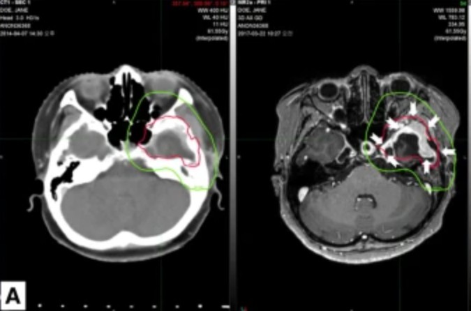 Journal of Neuro-Oncology tweet media