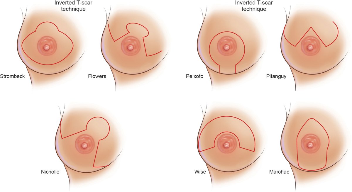 prsjournal's tweet photo. Need to know the latest on "Finesse in #Mastopexy and Mastopexy" and "Prepectoral #BreastReconstruction"?

Read this month's AMAZING CME articles, watch the videos, and then take the CME Tests for 1 hour of Category 1 Credit!

It all starts here: https://t.co/Rf8RiiVV6s https://t.co/fT47NYco6B