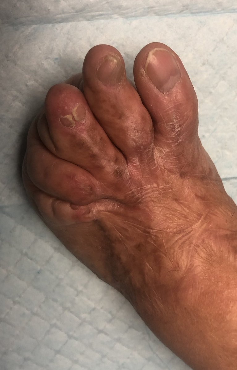 burnsurgeon1's tweet photo. #burnreconstruction stage one is to as Sir Harold Gillies stated, ‘Replace what is normal in normal position and retain it there’ https://t.co/7ghPyJkc4J