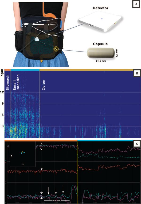 JPGNonline's tweet photo. The 3D-Transit system can noninvasively measure regional and whole gut transit times in adults at home.

Brinck et al use the system to measure #motility in healthy 🧒 and found it:
✔️ well-tolerated
✔️ no side effects
✔️ feasible to measure transit times

https://t.co/hDo8K9aj0M https://t.co/RlVk3z0KmK