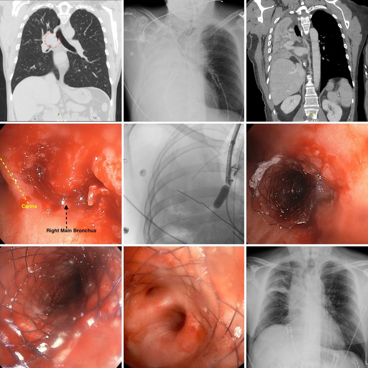 2nd chances. Right main bronchial tumor eventually progressing to complete right lung collapse and respiratory failure. Recannulated with fully covered self expanding metal stent to allow liberation from ventilator and go on to chemo-radiation. Another great case with <a href="/pulmo_dok/">Napoleon Puente</a>
