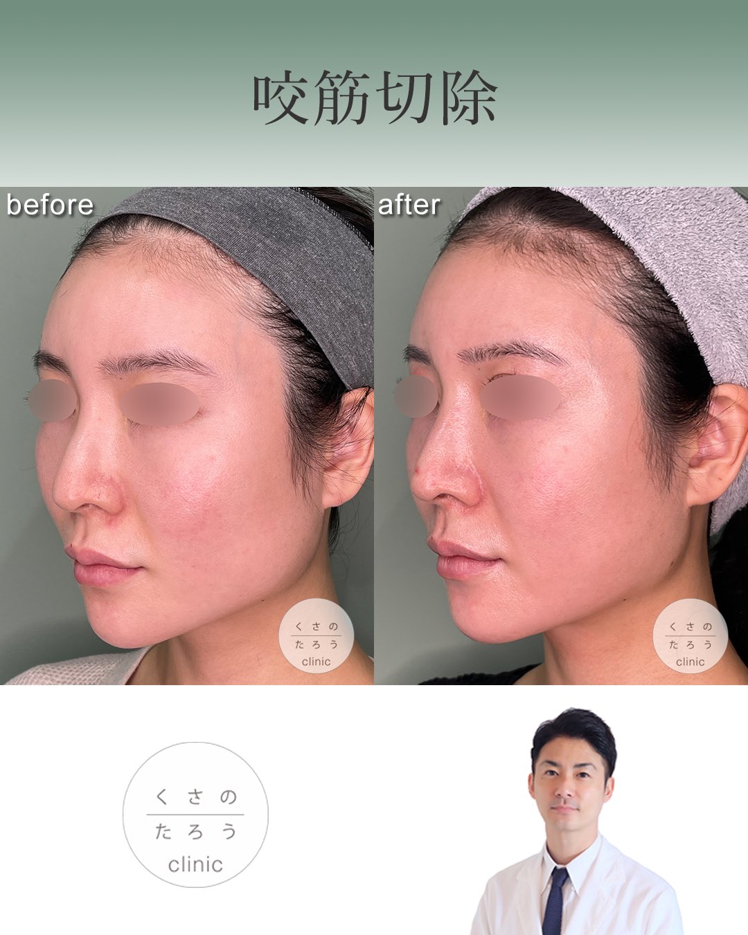 頬骨骨切り Twitter Search Twitter