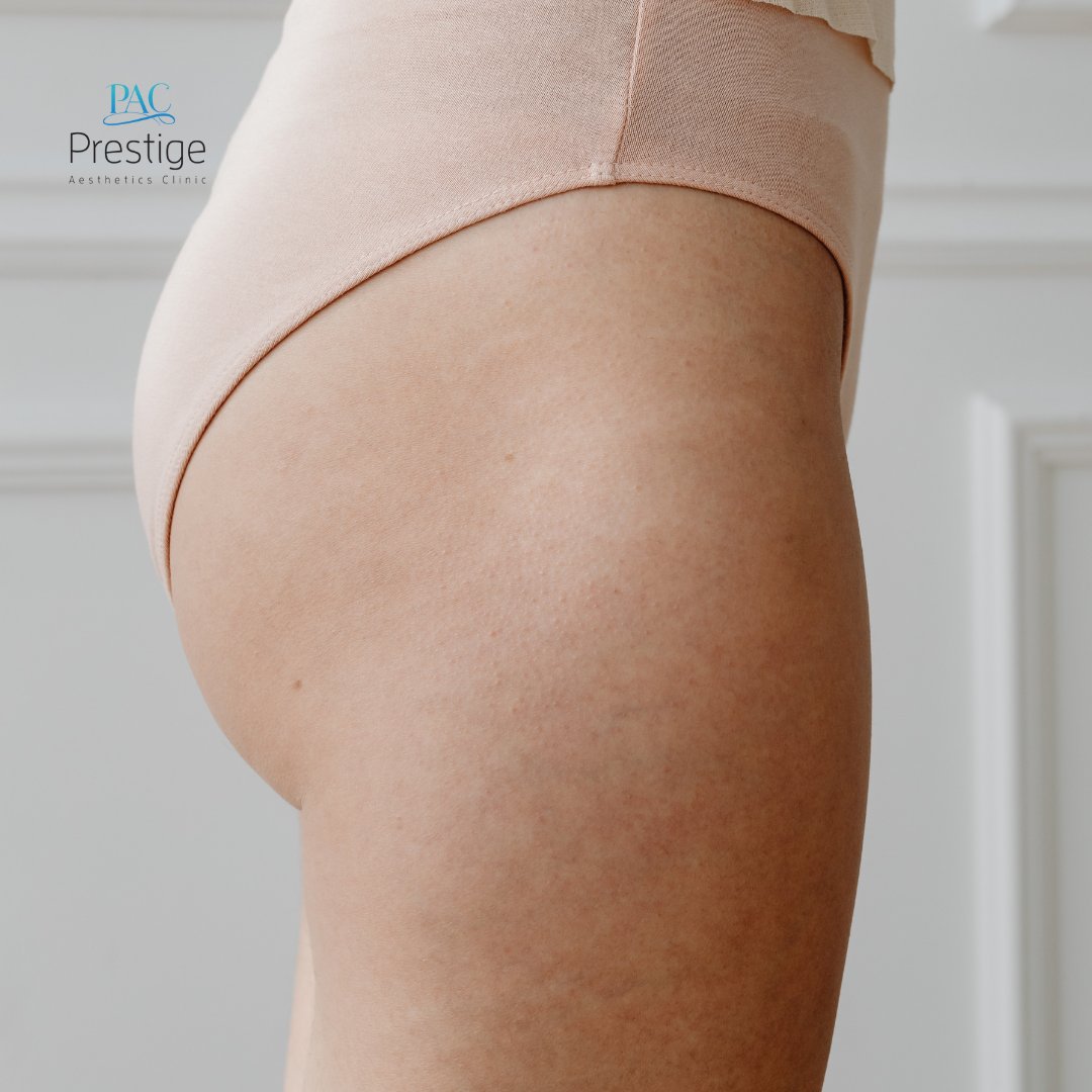 pacboca's tweet image. If you'd like to add a little extra volume to your figure and enhance the shape and look of your buttocks, then the Brazilian Butt Lift is just for you 🤗👉 bit.ly/3638Swm

#confident #fattransfer #bocamom #bocalife #bbl #liposuction #lipo #medspa