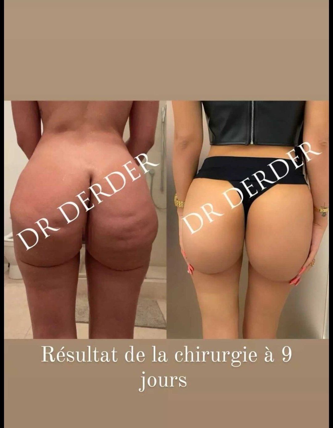 solife gossip on twitter apres des jours d alitement lea mary devoile enfin le resultat de son operation de chirurgie pour reduire la taille de ses fesses https t co rdjhdssswk twitter
