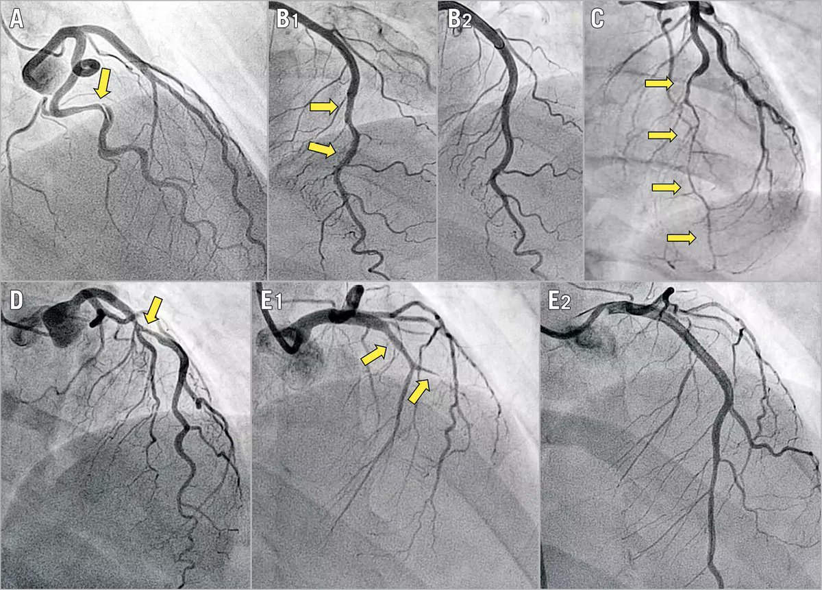Davide Capodanno (@dfcapodanno) on Twitter photo The angiographic classification of spontaneous coronary artery dissections correlates with outcome. In this study, patients with an angiographically circumscribed contained intramural haematoma (types 2A and 3) showed an increased risk of adverse events. eurointervention.pcronline.com/article/clinic… The angiographic classification of spontaneous coronary artery dissections correlates with outcome. In this study, patients with an angiographically circumscribed contained intramural haematoma (types 2A and 3) showed an increased risk of adverse events. eurointervention.pcronline.com/article/clinic…