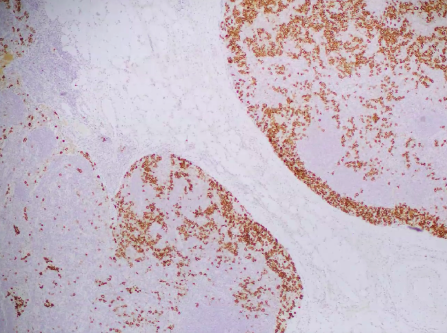 SibaElHussein's tweet photo. #lessonsfromthefridayunknowns Relapsed CHL with syncitial features and prominent intrasinusoidal involvement + discussion about grading systems by @ljmedeirosMD during #LJMFridayUnknowns➡️ https://t.co/eQD5adZ2uY 

#hemepath #pathtwitter #lymsm 

@KirillLyapichev @RMirandaMD https://t.co/IXoJuiLtXx