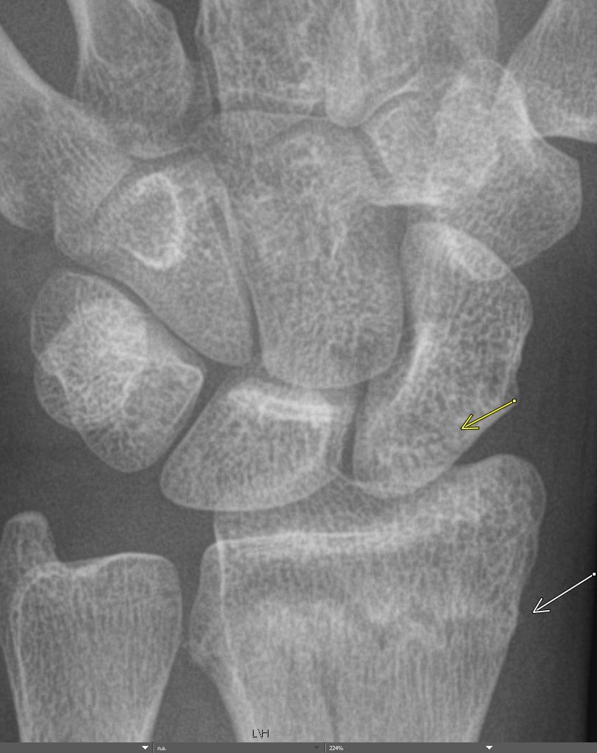 KhuranaBharti's tweet photo. Satisfaction of search is a common source of error in #Emergency #radiology #easytomiss non displaced scaphoid fracture in the presence of a distal radius fracture #radres #FOAMed #EDrad #EMrad #orthotwitter #medtwitter https://t.co/hTGSj9jDVW