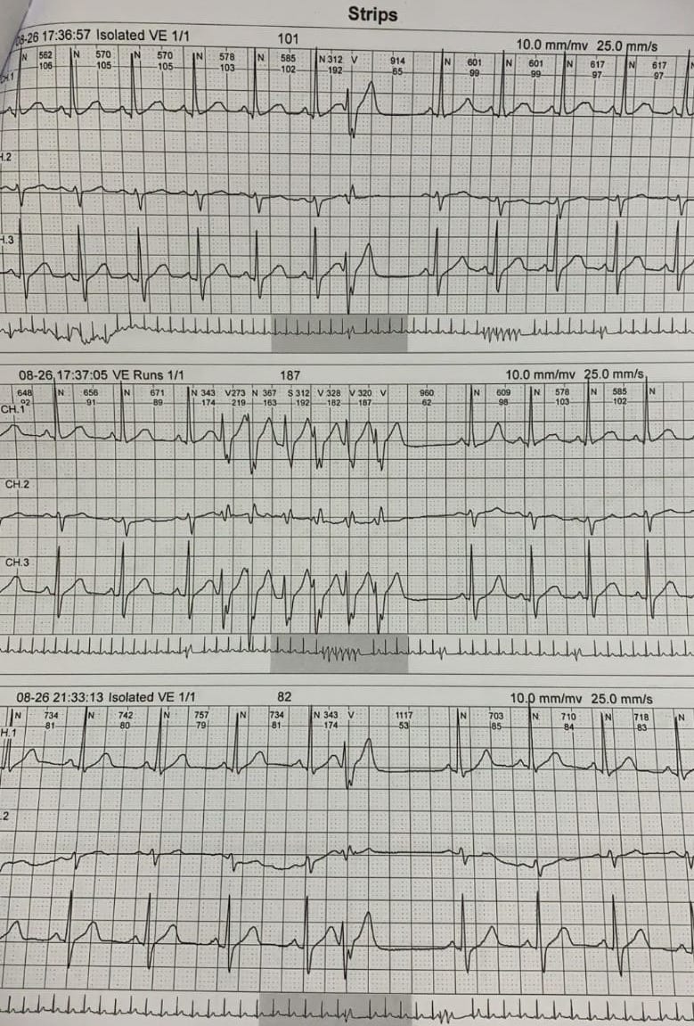 taylanakgun's tweet photo. 30 y M with palpitation and near syncope. Potentially serious NSVTs starting with the same PVC. Echo: mild left ventricular hypertrophy, ECG: shown below, cardiac MRI: subepicardial LGE+ at LV lateral site.  What would be your strategy? https://t.co/bSElzhCCFU