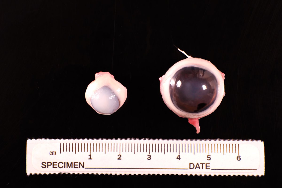 APowersPatho's tweet image. Day 3 of a gross pathology extravaganza. You don’t need supervision to see the lesion here. #twitterpathology #ophthopath #grosspathology #phthisisbulbi