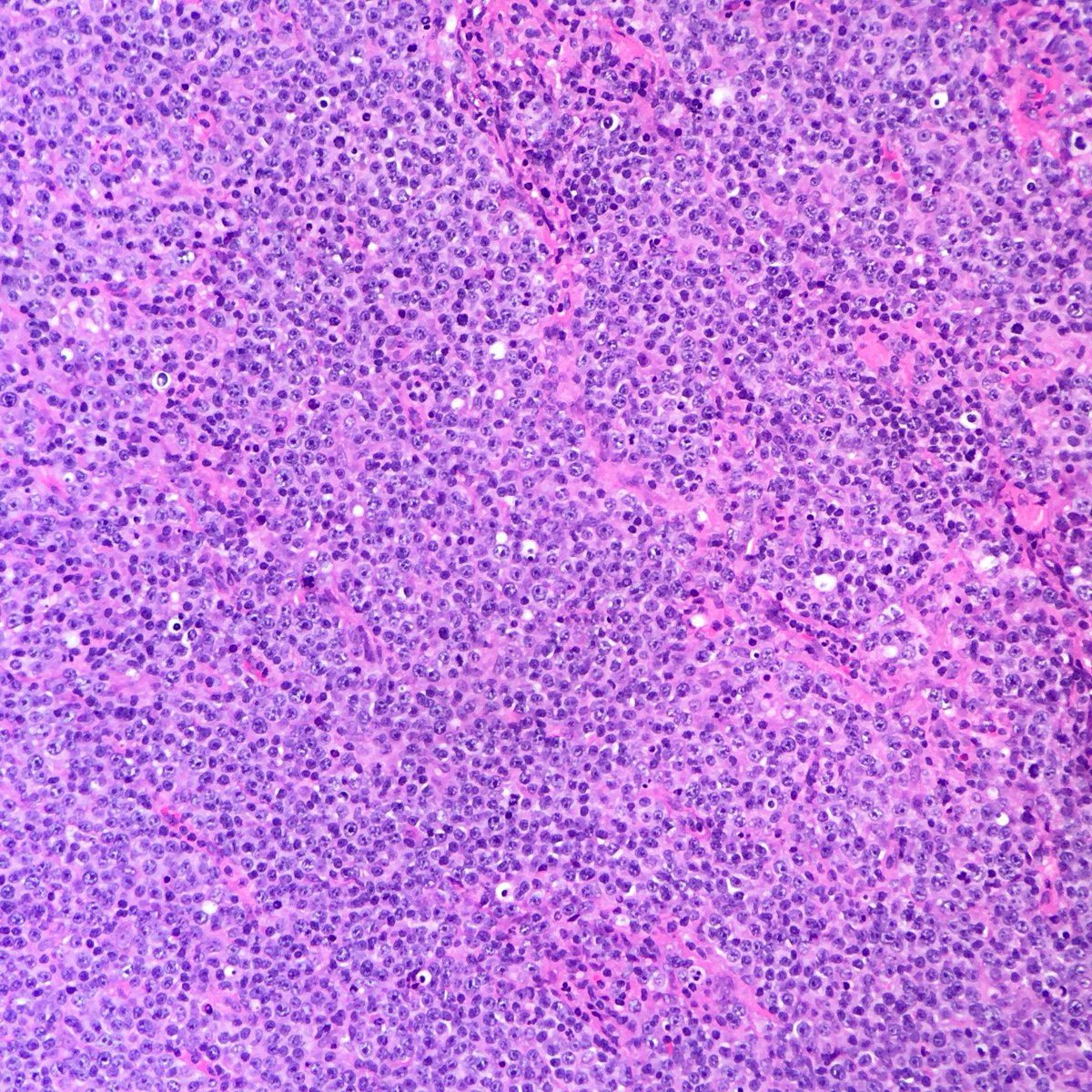 megothelioma's tweet photo. It's diffuse, it has large B-cells, it's a diffuse large B-cell lymphoma! Impressive Ki-67 in the third pic. #HemePath #PathTwitter #MSGPath https://t.co/yAsk6AFO6r