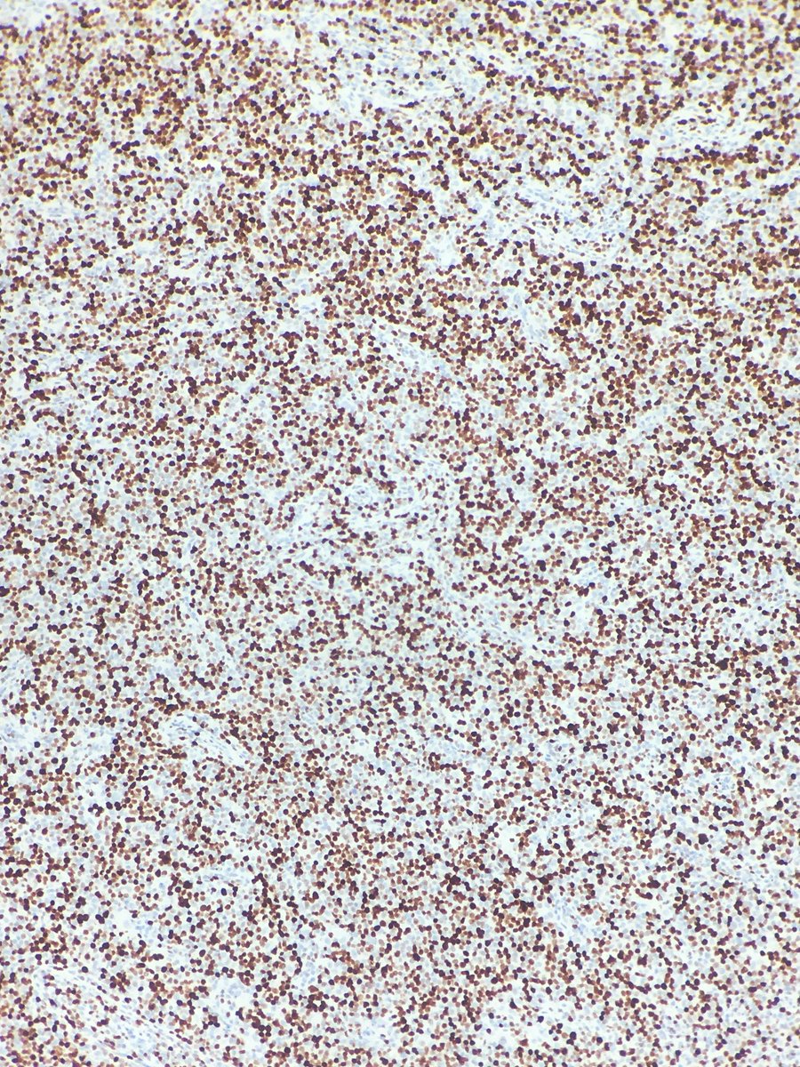 megothelioma's tweet photo. It's diffuse, it has large B-cells, it's a diffuse large B-cell lymphoma! Impressive Ki-67 in the third pic. #HemePath #PathTwitter #MSGPath https://t.co/yAsk6AFO6r