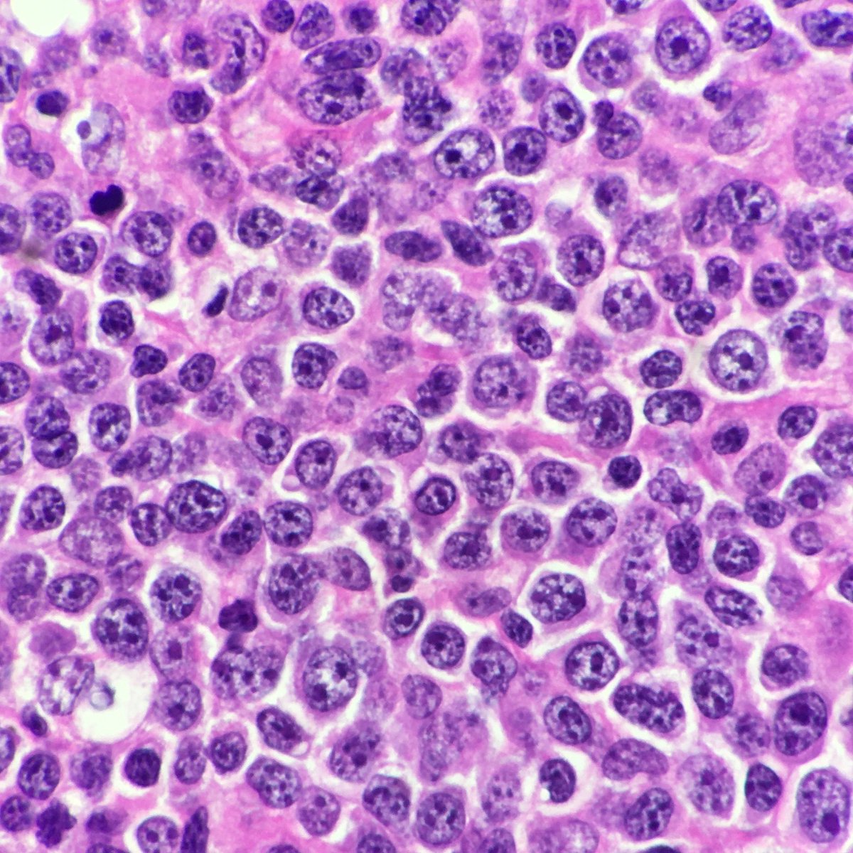 megothelioma's tweet photo. It's diffuse, it has large B-cells, it's a diffuse large B-cell lymphoma! Impressive Ki-67 in the third pic. #HemePath #PathTwitter #MSGPath https://t.co/yAsk6AFO6r